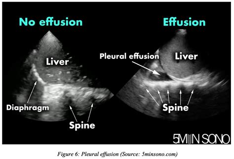 emDOCs.net – Emergency Medicine Educationpleural effusion Archives ...