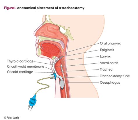 Tracheostomy Tube Insertion