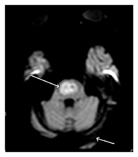 Diffusion weighted MRI image of our patient demonstrating central ...