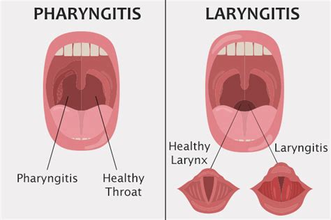 How to Manage Pharyngitis at Home - eMediHealth