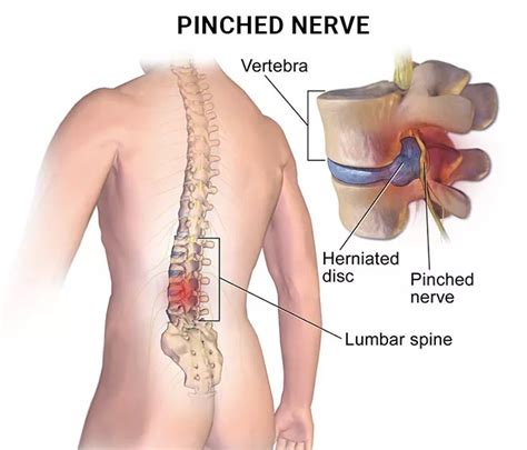 5 Common Symptoms of a Pinched Nerve - NJ's Top Orthopedic Spine & Pain ...