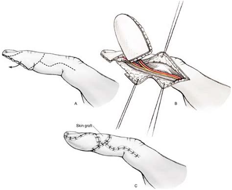 Homodigital Island Flap | Musculoskeletal Key