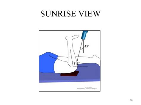 Sunrise Knee X Ray Positioning