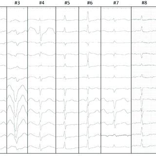 -P-wave morphology of all cases. The morphology of the P wave ...