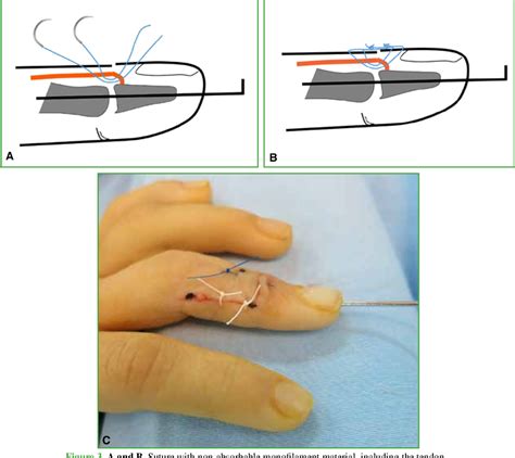 Figure 3 from Tenodermodesis for the Treatment of Late-Presenting ...