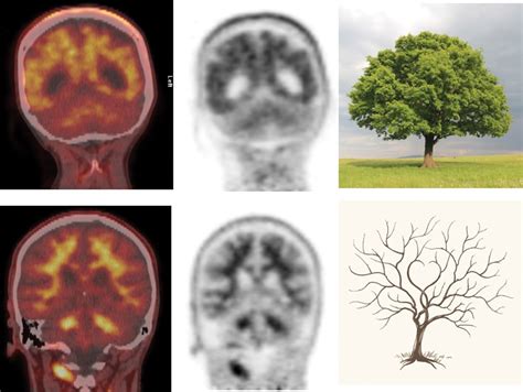 Amyloid PET imaging in clinical practice | Practical Neurology