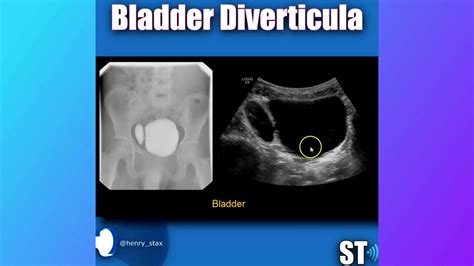 Bladder Diverticulum - YouTube