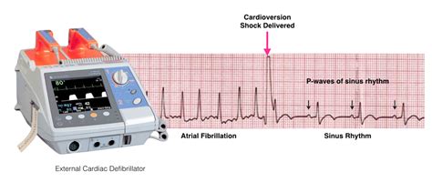 Electrical Cardioversion - One Heart Cardiology