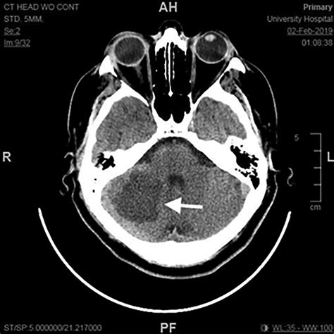 Cerebellar Stroke Mri