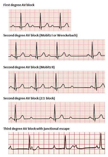 Heart block | Wiki | Everipedia