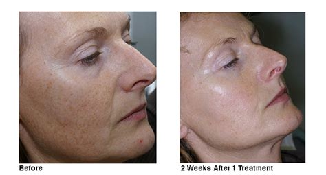 Removing Dark Spots on Face in Naperville | Naperville Age Spot Removal ...