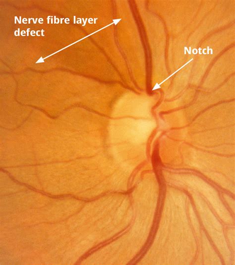 Community Eye Health Journal » The optic nerve head in glaucoma