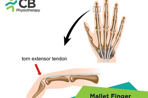 top-5-exercises-for-mallet-finger.webp