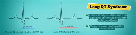 Long QT Syndrome - Causes, Symptoms, Diagnosis, Treatment & Prevention