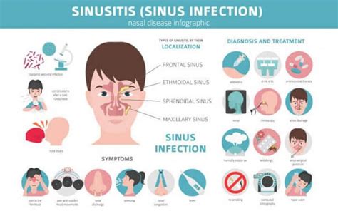 Can Root Canal cause Sinus Infection? Dental Sinus Infection Symptoms ...