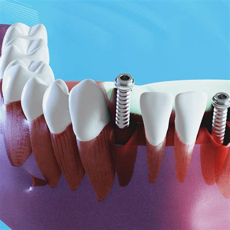 The Difference Between Ceramic and Titanium Implants | Dr.Dan Hagi ...