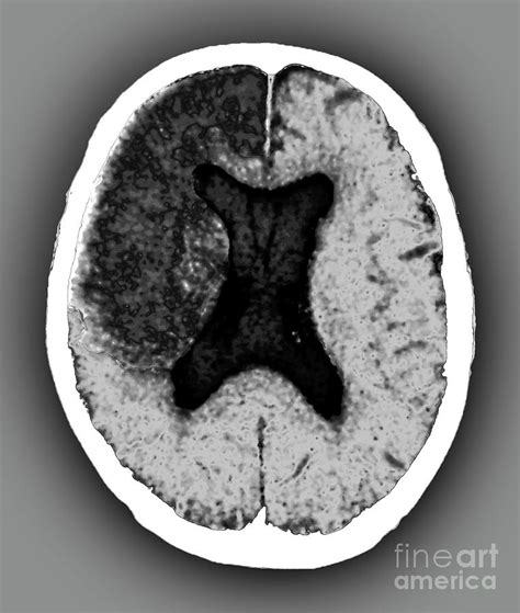 Cerebral Infarction Photograph by Zephyr/science Photo Library