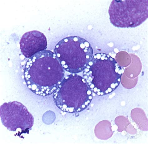 Burkitt leukemia - 2.