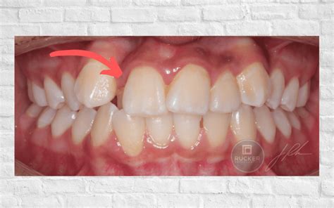 Orthodontics Case of Anterior Crossbite - Rucker Orthodontics