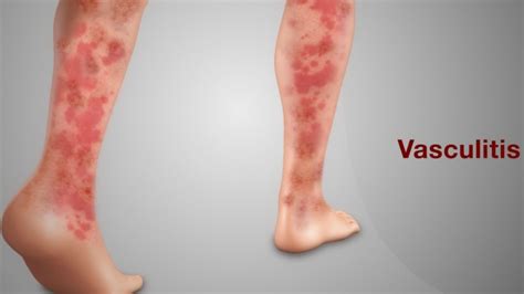 Vasculitis: Symptoms, Causes And Best Treatment Methods