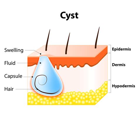 [DIAGRAM] Diagram Of A Cyst - MYDIAGRAM.ONLINE