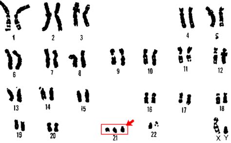 Trisomy 21 or ”Down Syndrome” – Celia Foundation