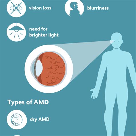 Dry Macular Degeneration: Overview and More