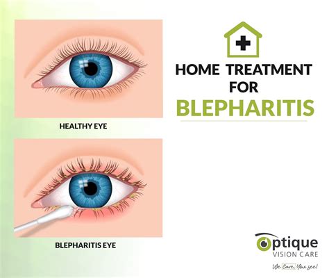 What Causes Blepharitis Swollen Eyelids