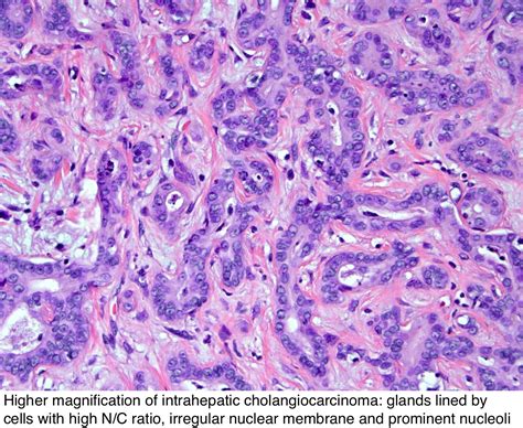 Pathology Outlines - Cholangiocarcinoma (intrahepatic / peripheral)