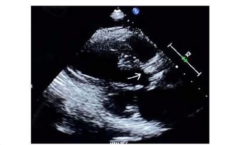 2D Echo showing a well-seated bioprosthetic aortic valve. | Download ...