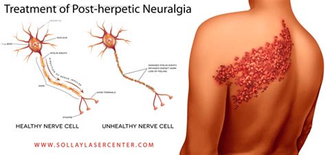 Treatment of Post-herpetic Neuralgia (Nerve Pain After Shingles Attack ...