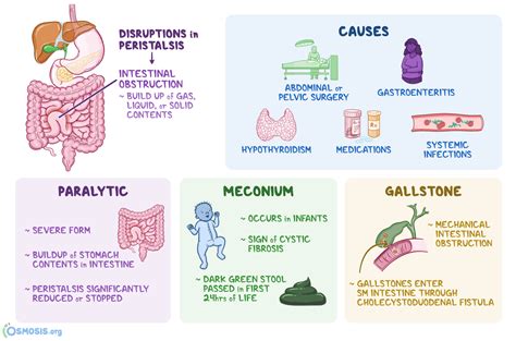 Ileus: What Is It, Types, Causes, Diagnosis, Treatment, and More | Osmosis