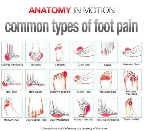 Anatomy Of Foot Pain - ANATOMY