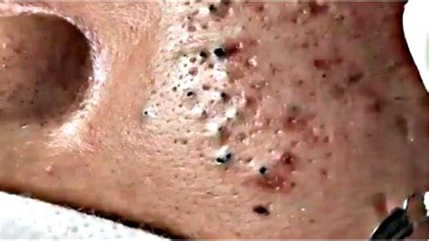 Blackheads & Milia, Big Cystic Acne Blackheads Extraction Whiteheads ...