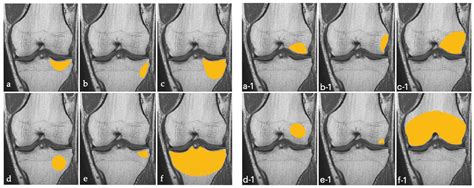 JCM | Free Full-Text | Is Primary Bone Marrow Edema of the Knee ...