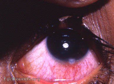 Phlyctenular keratoconjunctivitis. EyeRounds.org: Online Ophthalmic Atlas