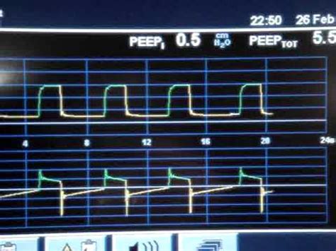 Obtaining a Intrinsic PEEP (PEEPi) measurement with the PB840 ...