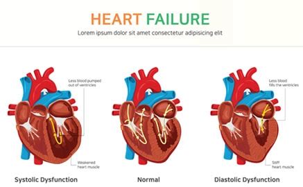 Conquer All Your Heart Failure ICD-10-CM Coding Conundrums : ICD-10-CM