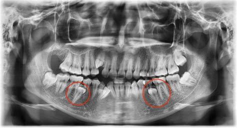 Buried/Extra (Supernumerary) Teeth Removal - Tes Clinic for Face and Jaw