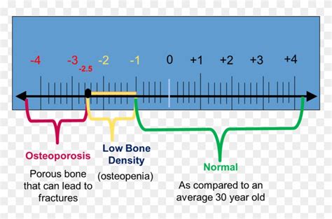 Osteoporosis Bone Density