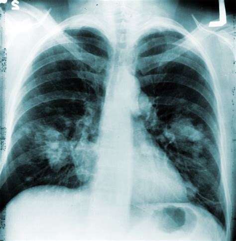 Annual Chest X-rays Don’t Cut Lung Cancer Deaths | National Institutes ...