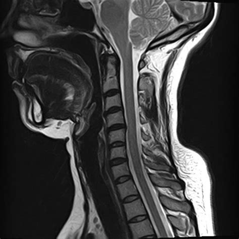 Mri Cervical Spine Neck Pain