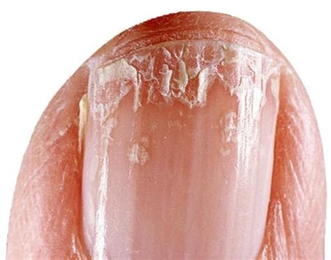 Split Fingernails (Onychoschizia): Symptoms, Causes & Remedies