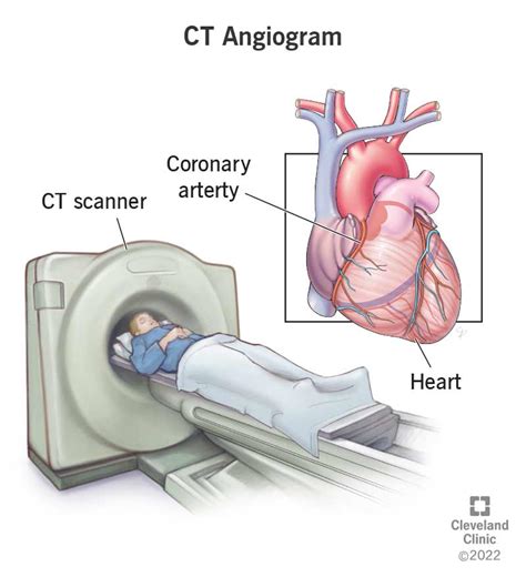 CT Coronary Angiogram