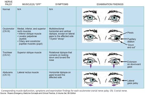 Superior Gaze Palsy