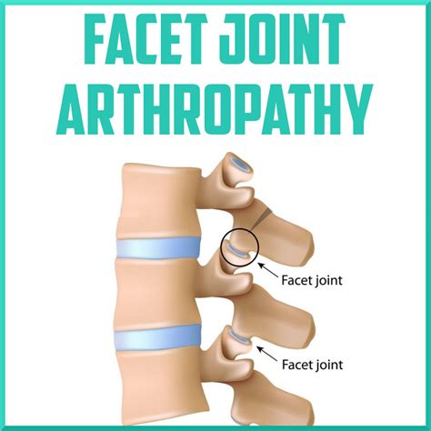 Facet Joint Arthropathy - Sports Medicine Review