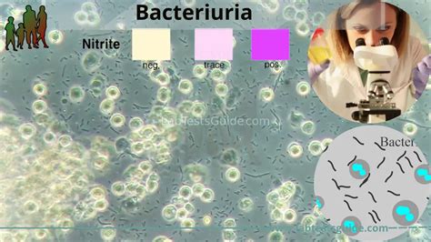 Bacteriuria | Lab Tests Guide