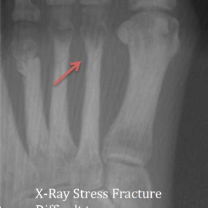 Hairline Fractures: Dx w/ In-Office CT Imaging - CurveBeam AI