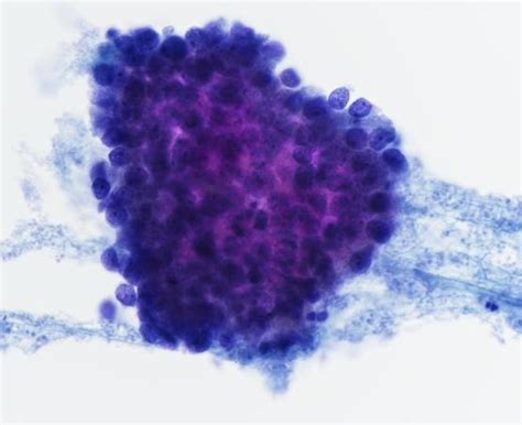 Male, 86 years. FNA thyroid. | cytology.ch