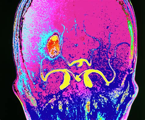 Coloured Mri Scan Of A Cerebral Infarction Photograph by Simon Fraser ...